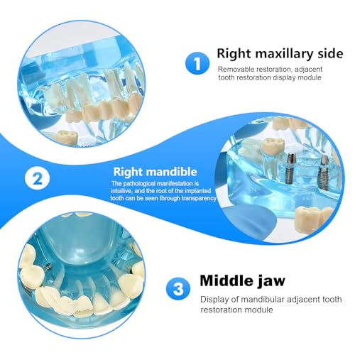 Dental Model with Removable Teeth, Dental Model, Transparent Model for Diseased Teeth, Transparent Tooth Model for Education, Clinic and Patient Demonstration, Blue