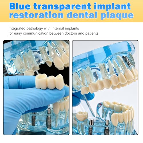 Dental Model with Removable Teeth, Dental Model, Transparent Model for Diseased Teeth, Transparent Tooth Model for Education, Clinic and Patient Demonstration, Blue