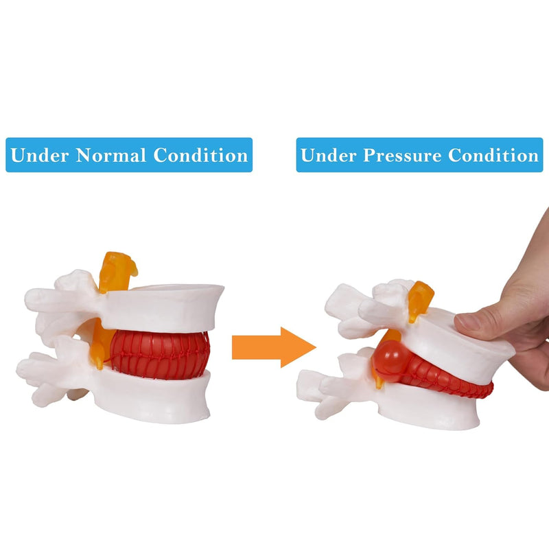 NLShan Human Anatomical Lumbar Disc Herniation Model, Portable Herniated Lumbar Vertebrae Disc, 1.5 Times Life Size Lumbar Spine Model for Learning, Teaching and Demonstrating Lumbar Disc Herniation Model-01