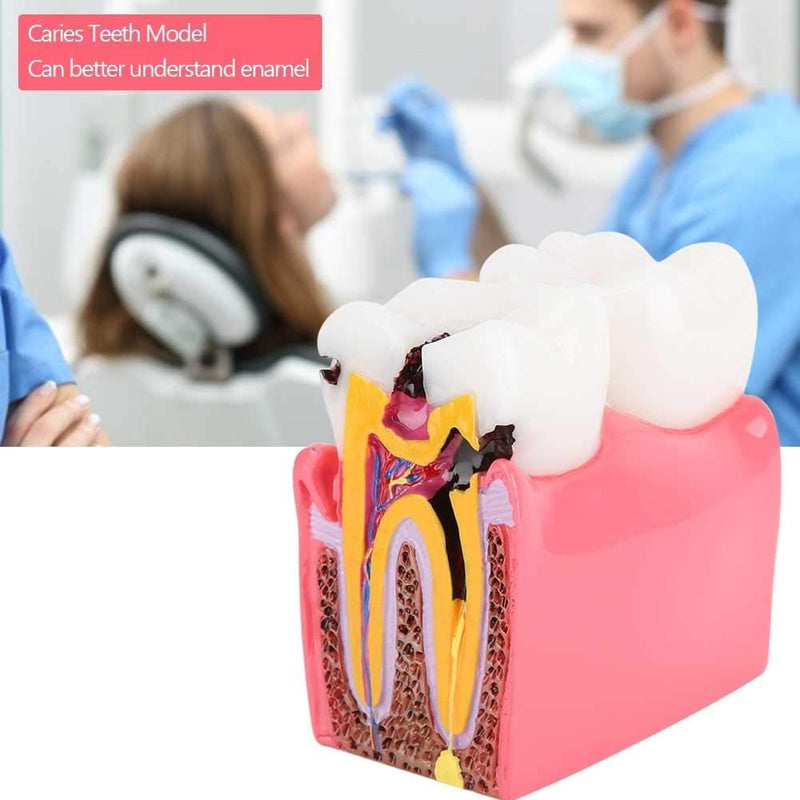 Dental Anatomy Model, Caries Comparison Study Models Dentist Dental Anatomy Training Dental Caries Development Model