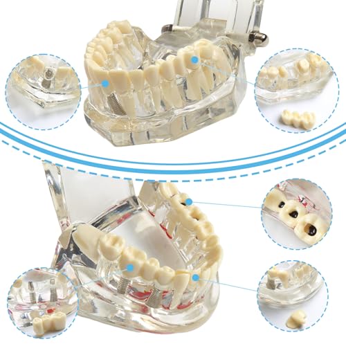 Tooth Model, Transparent Tooth Model with Removable Crown/Bridge, White | Implant dental model, orthodontic dental model, implant demo with removable crown/bridge for training