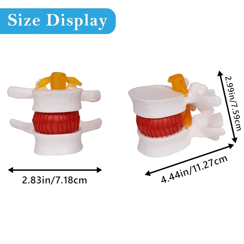NLShan Human Anatomical Lumbar Disc Herniation Model, Portable Herniated Lumbar Vertebrae Disc, 1.5 Times Life Size Lumbar Spine Model for Learning, Teaching and Demonstrating Lumbar Disc Herniation Model-01