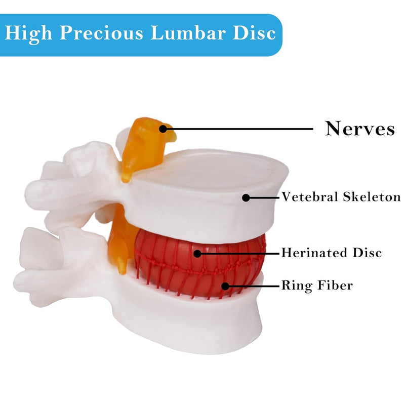 NLShan Human Anatomical Lumbar Disc Herniation Model, Portable Herniated Lumbar Vertebrae Disc, 1.5 Times Life Size Lumbar Spine Model for Learning, Teaching and Demonstrating Lumbar Disc Herniation Model-01