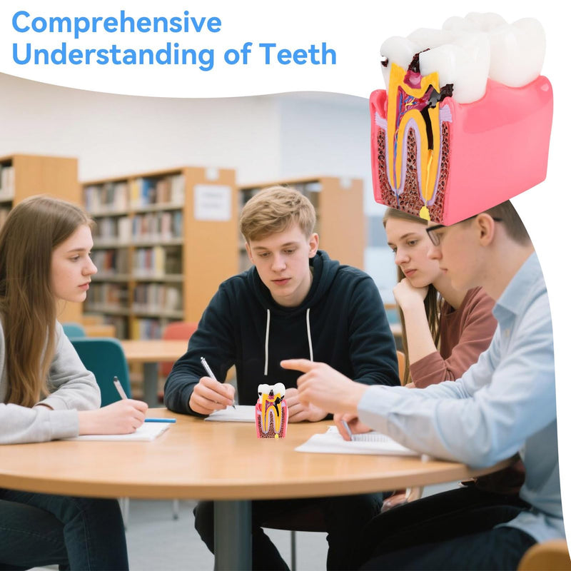 Dental Anatomy Model, Caries Comparison Study Models Dentist Dental Anatomy Training Dental Caries Development Model