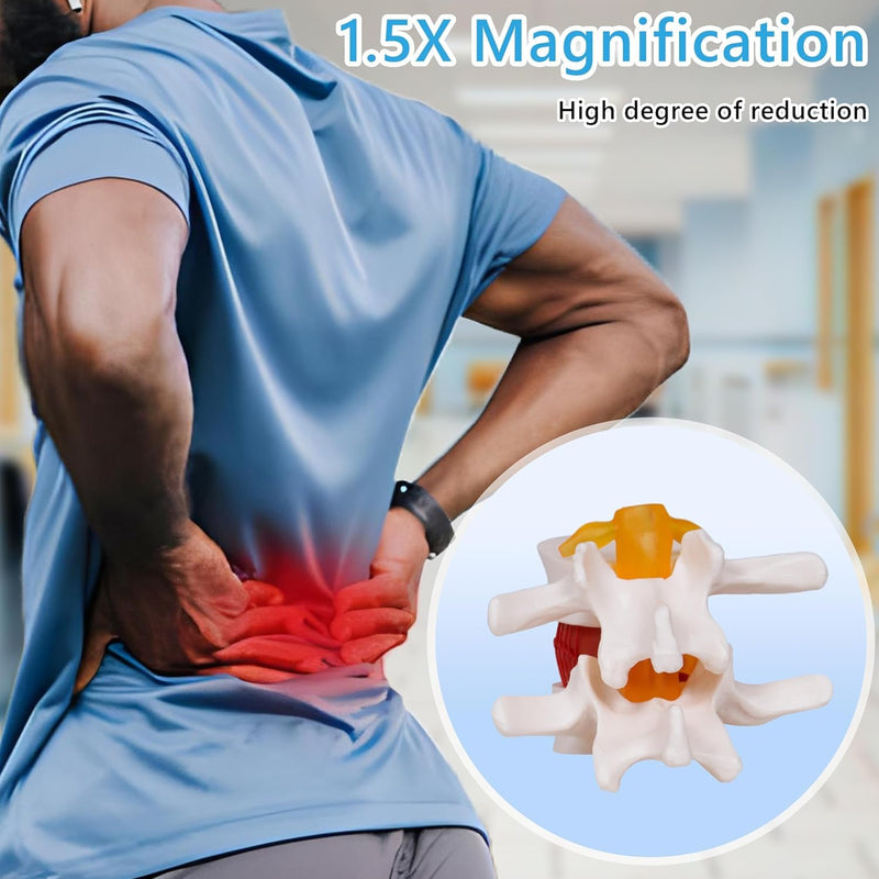 NLShan Human Anatomical Lumbar Disc Herniation Model, Portable Herniated Lumbar Vertebrae Disc, 1.5 Times Life Size Lumbar Spine Model for Learning, Teaching and Demonstrating Lumbar Disc Herniation Model-01