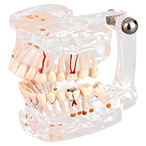 Walfront Transparent Dental Implant Teaching Study Standard Teeth Model Demonstration Pathological Educational Dental Teaching Tools