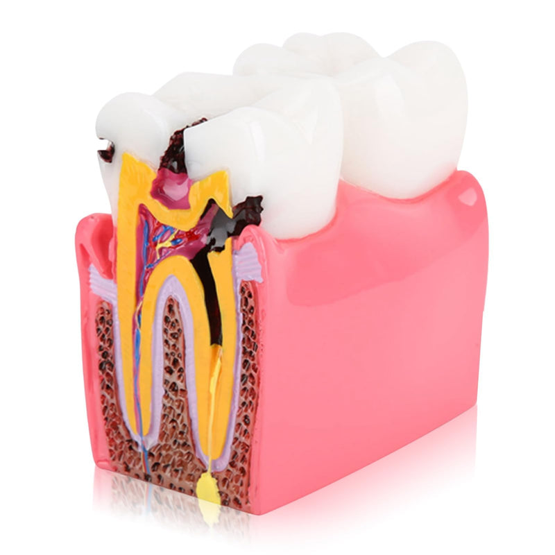 Dental Anatomy Model, Caries Comparison Study Models Dentist Dental Anatomy Training Dental Caries Development Model