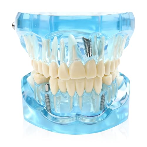 Dental Model with Removable Teeth, Dental Model, Transparent Model for Diseased Teeth, Transparent Tooth Model for Education, Clinic and Patient Demonstration, Blue