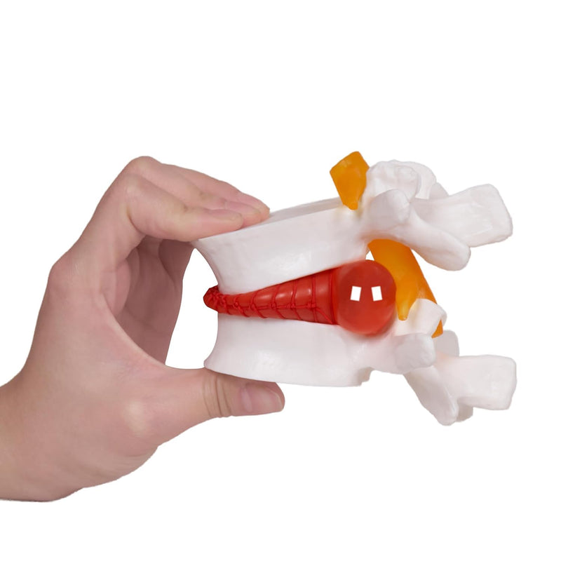 NLShan Human Anatomical Lumbar Disc Herniation Model, Portable Herniated Lumbar Vertebrae Disc, 1.5 Times Life Size Lumbar Spine Model for Learning, Teaching and Demonstrating Lumbar Disc Herniation Model-01