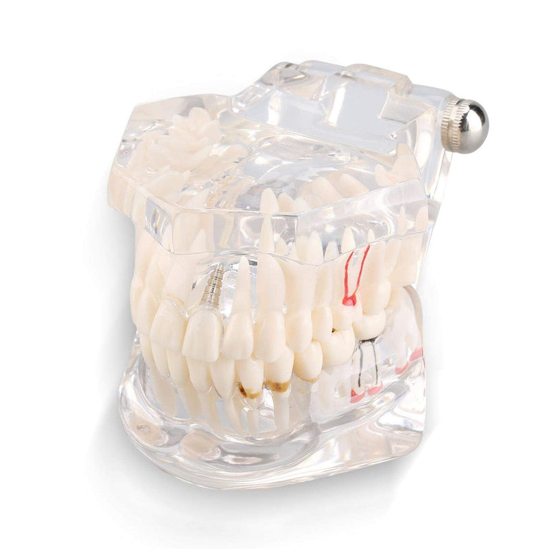 Tooth model, Akozon Dental Standard Teaching Tooth Model Children Prosthesis Model Removable Tooth Pathological Teaching Model Demonstration Tool