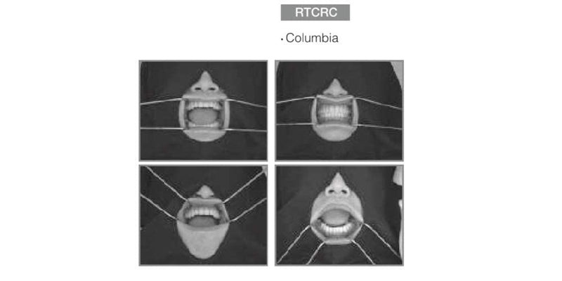 Osung RTCRC Dental Columbia Cheek Retractor