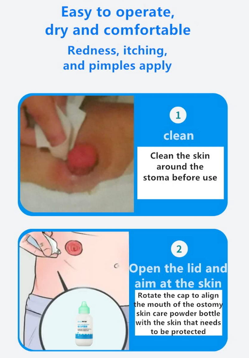 Ovand 8101 Stoma Powder,Ostomy Skin Barrier Powder,Ostomy Bag Protect Skin Barrier Adhesive & Filler.