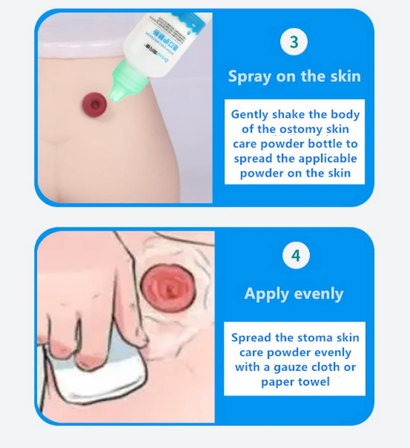 Ovand 8101 Stoma Powder,Ostomy Skin Barrier Powder,Ostomy Bag Protect Skin Barrier Adhesive & Filler.