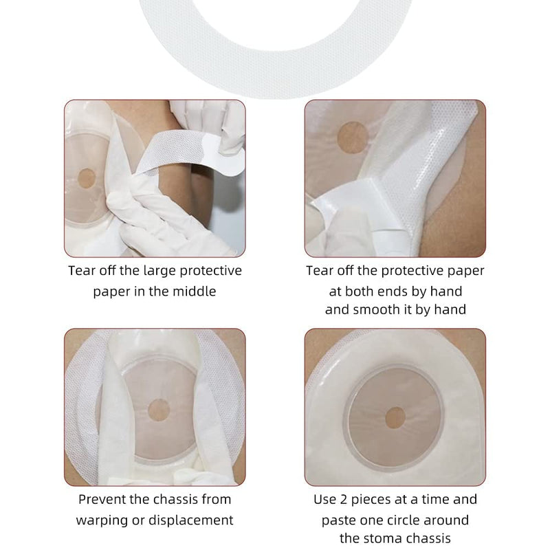 Ostomy Supplies Skin Barrier Strips,Elastic Hydrocolloid Skin Extender Strips for Colostomy Bags,Universal Waterproof Half Rings. (20 Pieces) 20 Pieces