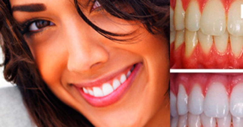 Expertwhite Extreme 44% Teeth Whitening Gel (6-gels)