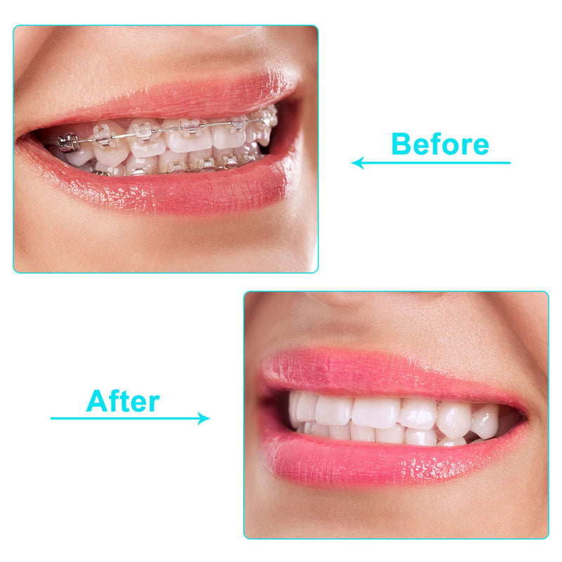 60 Pieces Aligner Chewies Aligner Tray Seaters Chewies for Aligner Chompers Aligner Trays Seater Orthodontic Chewies, 6 Colors