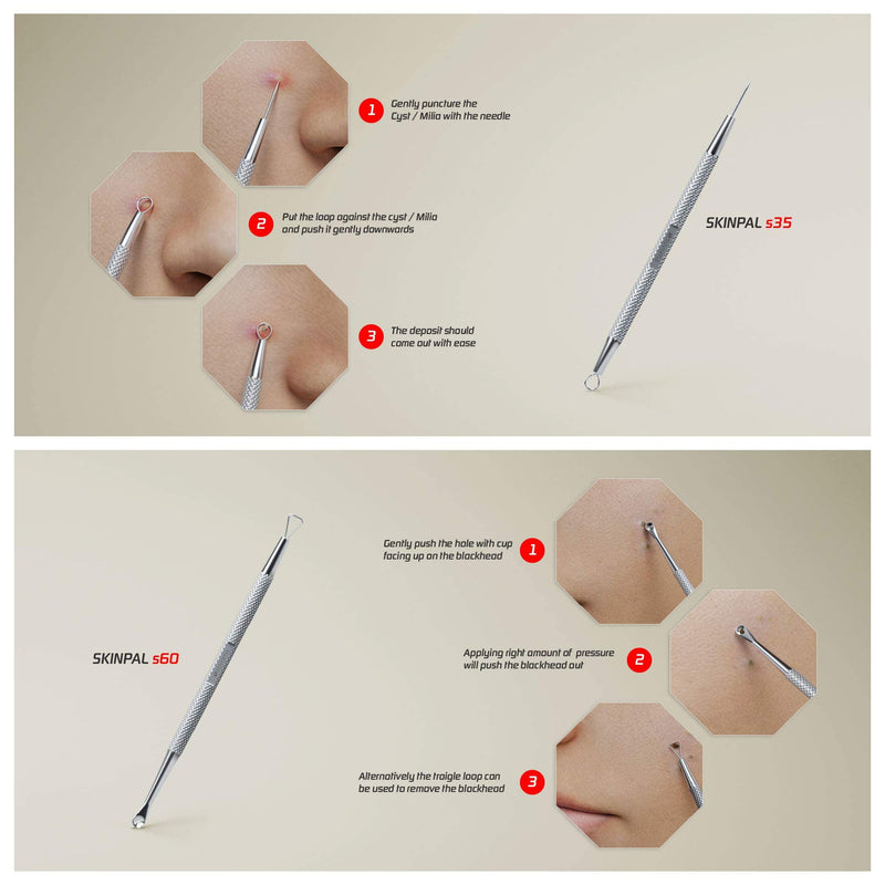 Suvorna Skinpal S100 Pimple Popper tool Kit. Lancet for Facial Milia Remover. Blackhead, Whitehead Extractors, Zit, Blemish & Comedone Removal. Dermatologist Grade Steel. Approved by Estheticians.