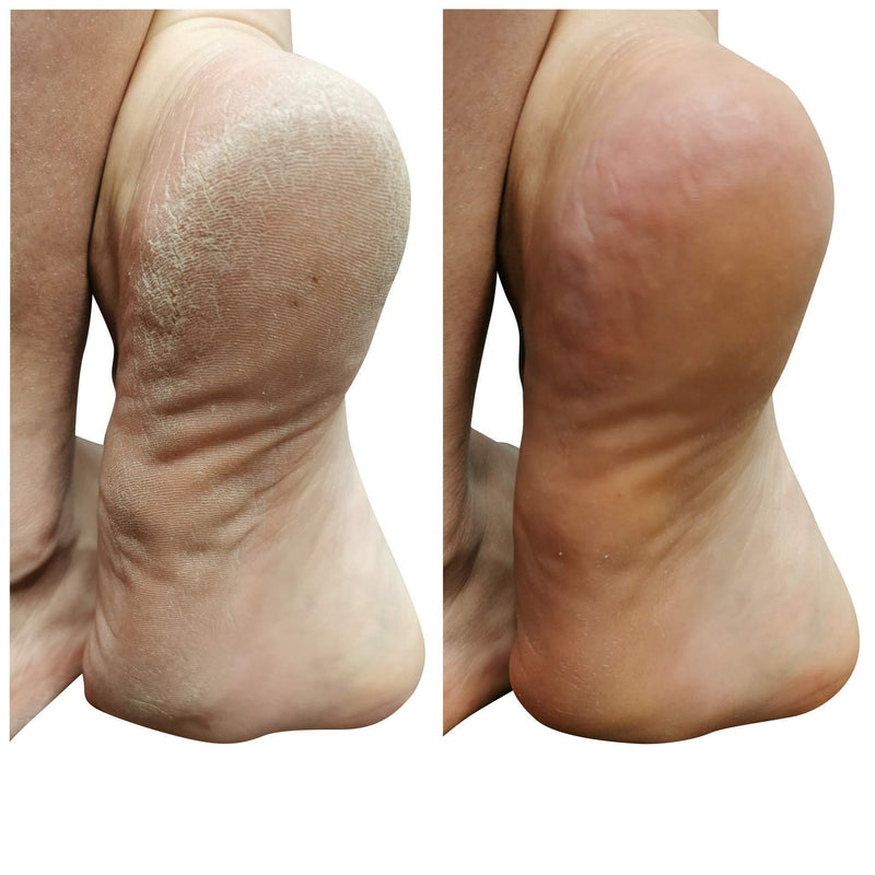 8oz Callus Remover gel for feet for a professional pedicure. Better results than, foot file, pumice stone, foot scrubber, foot buckets & callus shaver. Rid ugly callouses from feet in minutes!