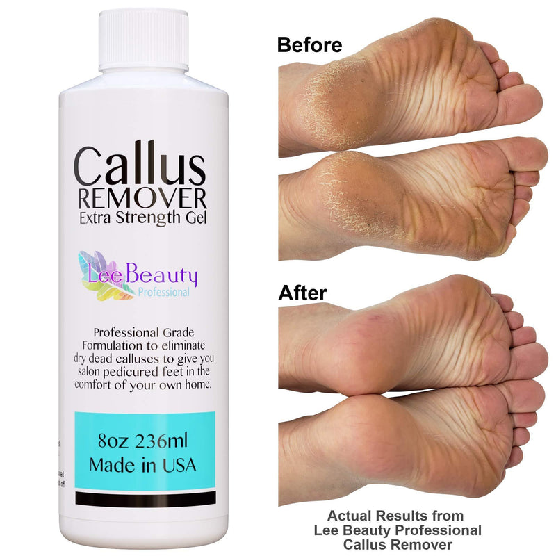 8oz Callus Remover gel for feet for a professional pedicure. Better results than, foot file, pumice stone, foot scrubber, foot buckets & callus shaver. Rid ugly callouses from feet in minutes!