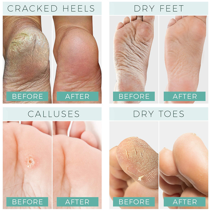 Foot Peel Mask - 2 Pack - For Cracked Heels, Dead Skin & Calluses - Make Your Feet Baby Soft & Get a Smooth Skin, Removes & Repairs Rough Heels, Dry Toe Skin - Exfoliating Peeling Natural Treatment Pack of 2