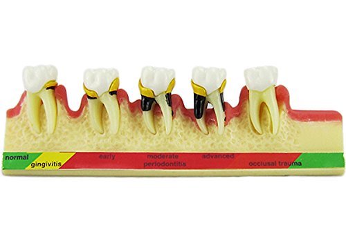 Dental Periodontal Disease assort Tooth Teeth Typodont Study Teaching Model New